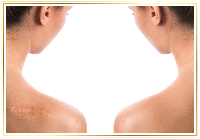 a woman's back and shoulders with scar