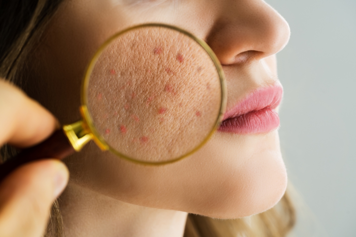 Skin Rejuvenation Treatment in Melbourne & Tampa, FL