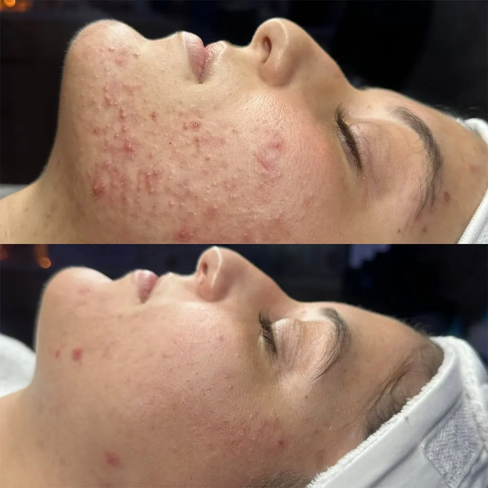 acne scaring ar aesthetics in tampa fl two