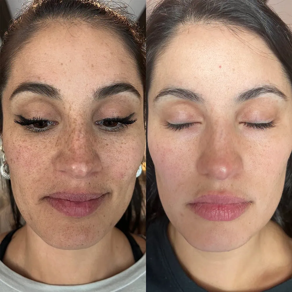 BBL before after AR Aesthetics