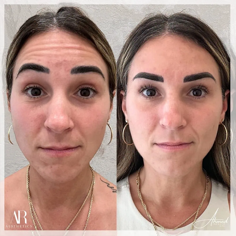 Botox, Dysport, Letybo before and after AR Aesthetics