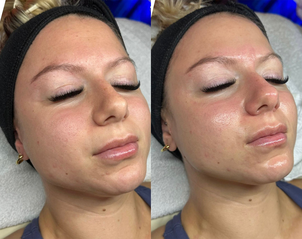 Facial before and after AR Aesthetics