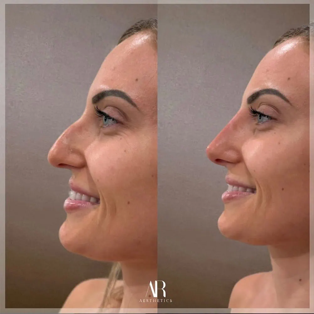 Liquid Rhinoplasty fl a&b