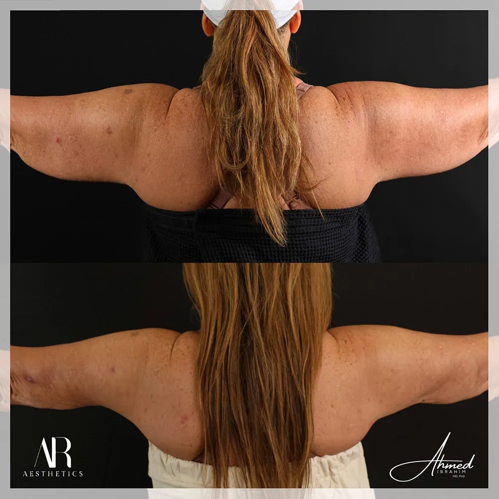 Arm Sculpt before after One AR Aesthetics