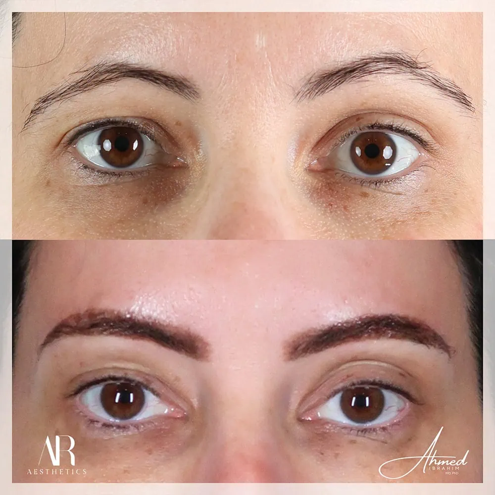 Brow Lift before after One AR Aesthetics