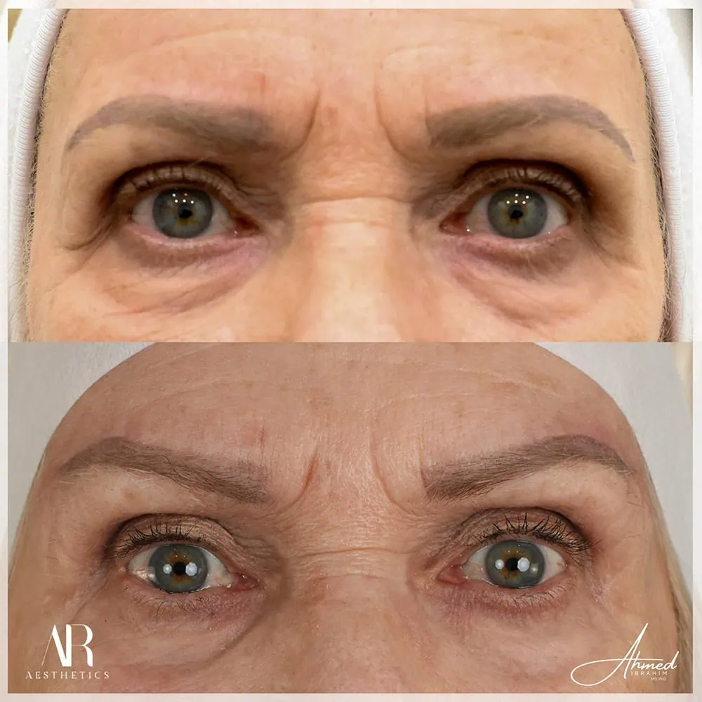 Brow Lift before after Two AR Aesthetics