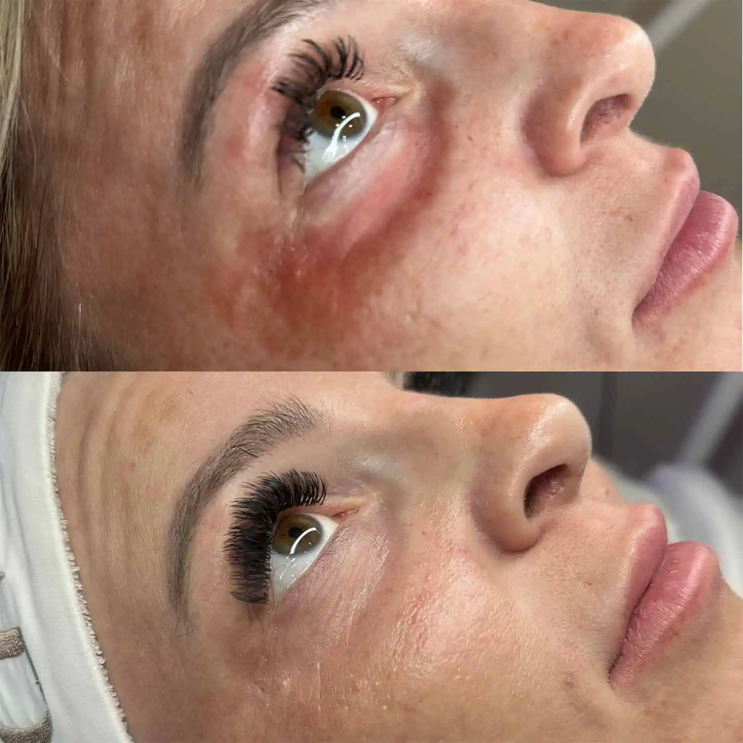 Chemical Peels Before After AR Aesthetics in Fl