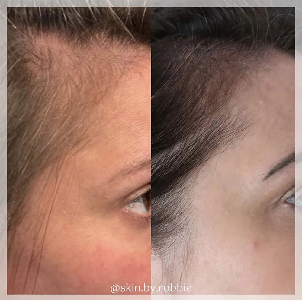 Hair Restoration Before After AR Aesthetics in Fl
