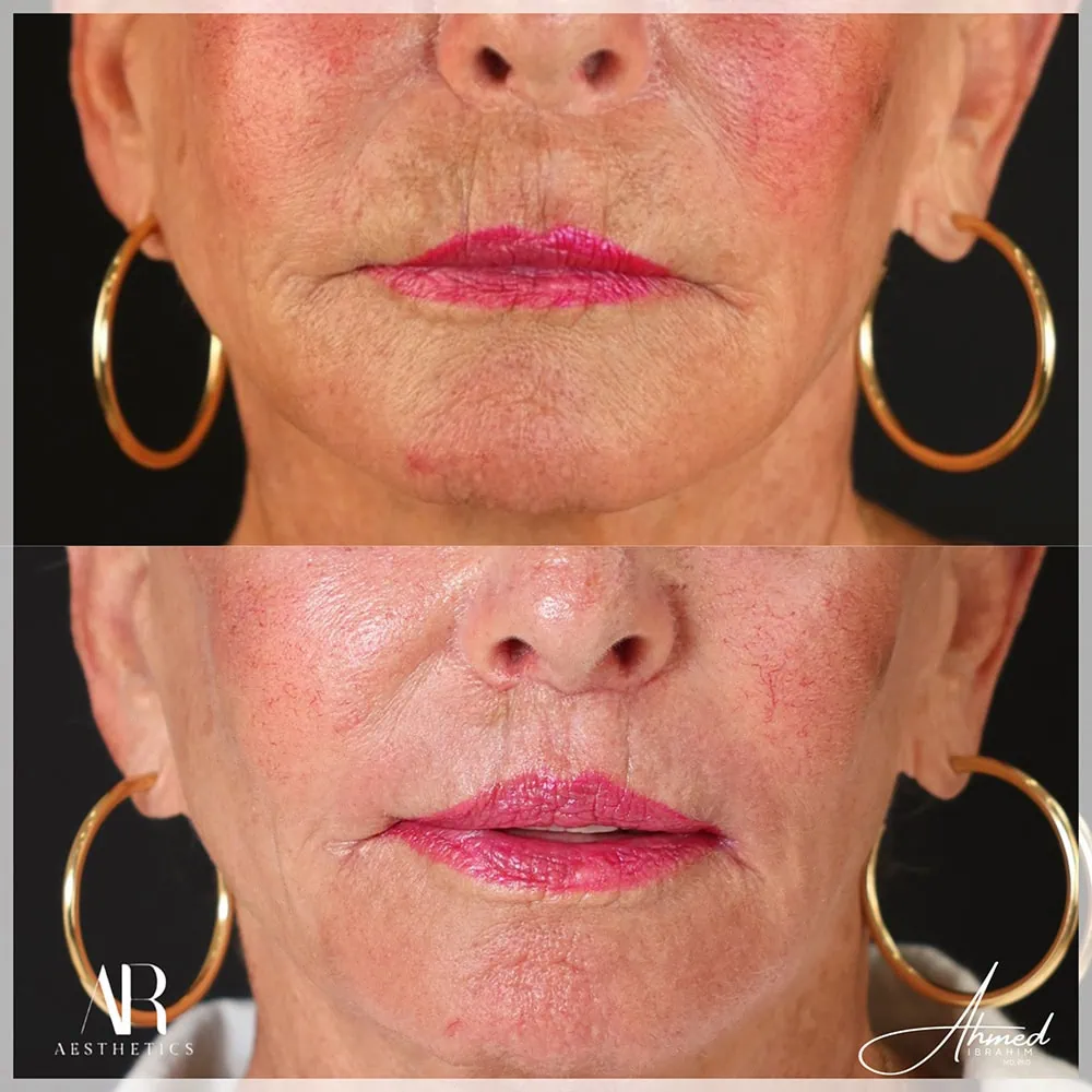 Lip Lift before after AR Aesthetics