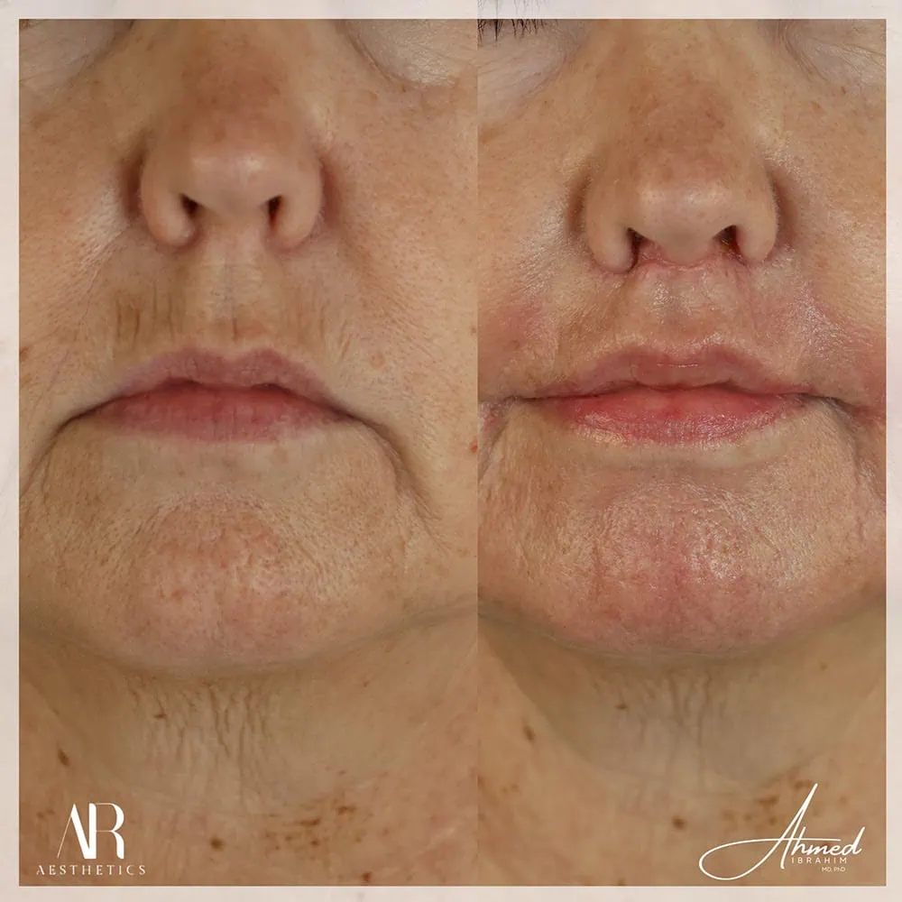 Lip Lift before after Two AR Aesthetics