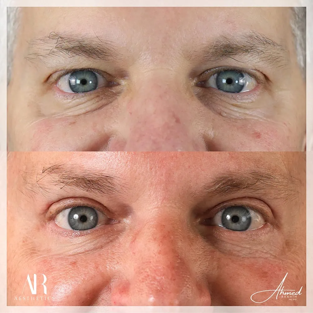 Lower Eye before after AR Aesthetics
