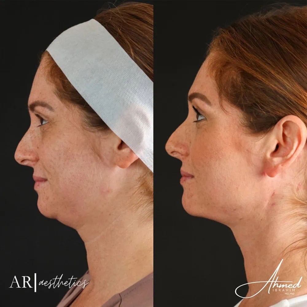 Neck before after three AR Aesthetics