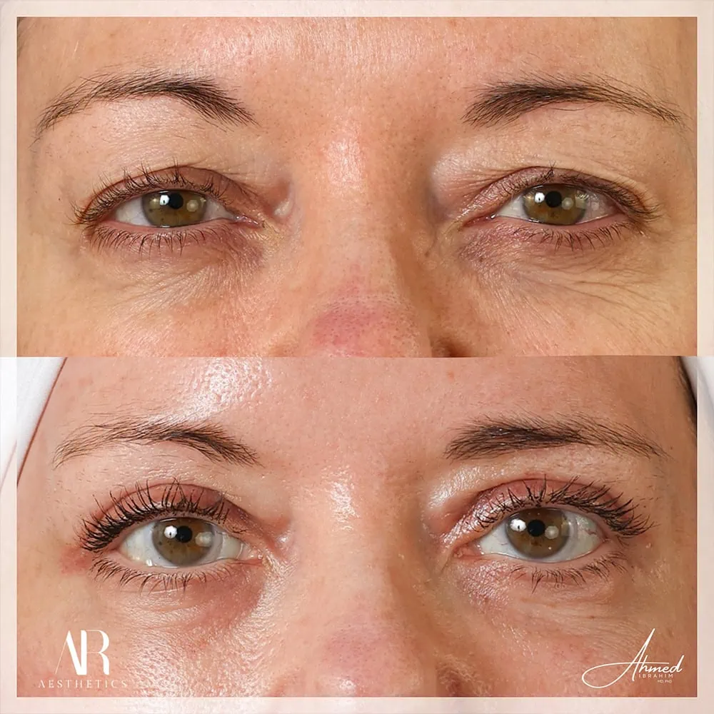 Upper Eye before after one AR Aesthetics
