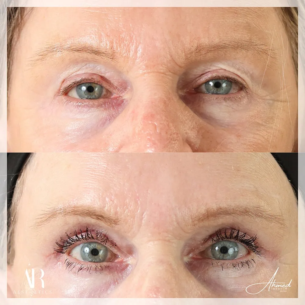 Upper Eye before after two AR Aesthetics